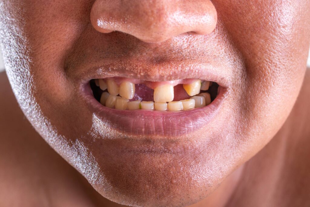 Drug that can regrow missing human teeth finally enters clinical trials